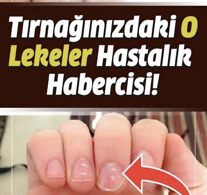 TEHLİKE  Tırnaktaki Beyaz Lekeler Neden Olur?