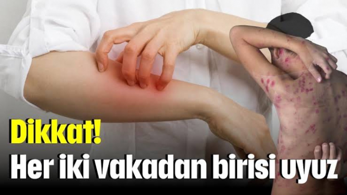 Türkiye'de uyuz vakaları yüzde 30 arttı (Uyuz hastalığı neden olur, belirtileri neler, nasıl bulaşır?)
